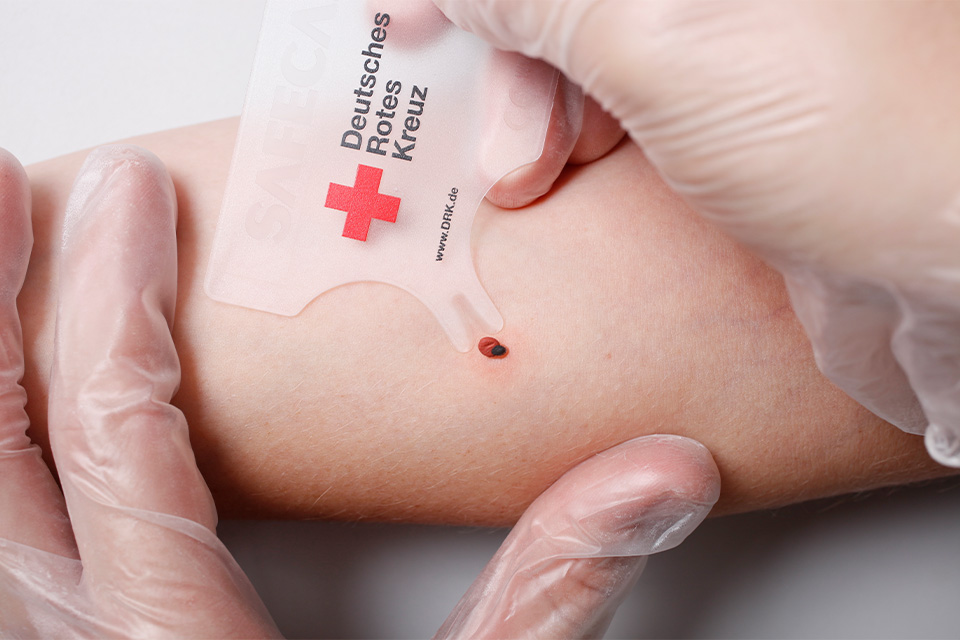 Eine Zecke wird mittels einer Zeckenkarte entfernt.